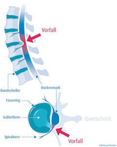 PHYSIOLOGA. Wenn der Körper den gesunden Schlaf wiederfindet! 2 Schema Bandscheibenvorfall